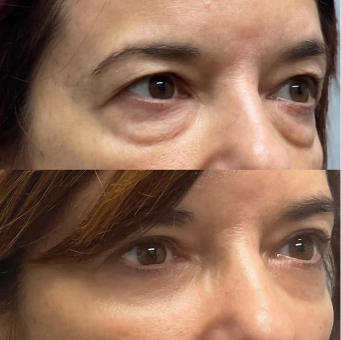 Micro Needle Eye Patches