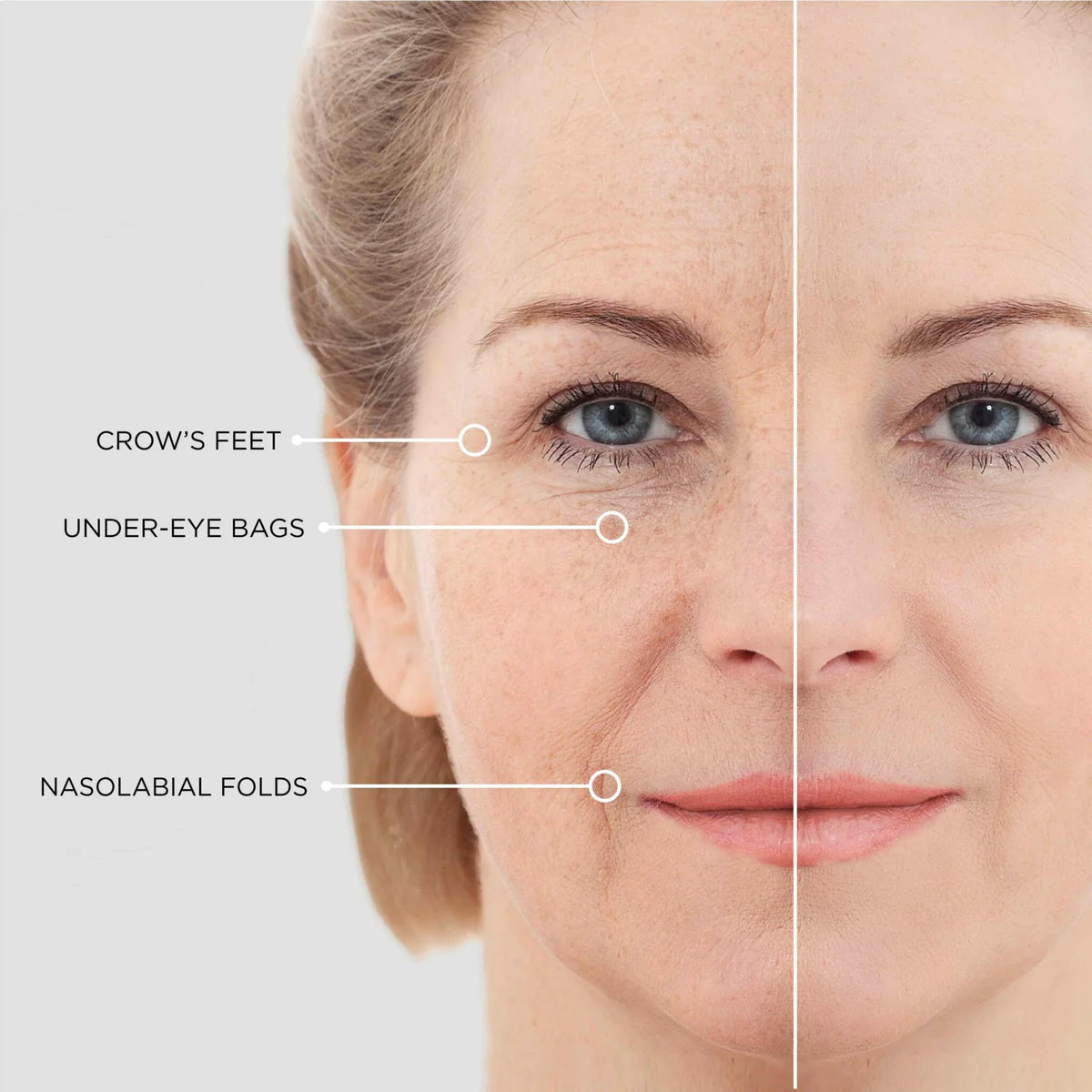 Micro Needle Eye Patches